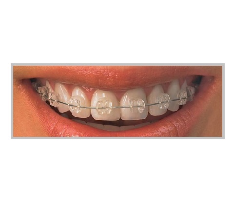 Braces and orthodontics treatment