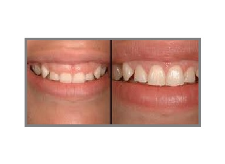 Gum disease treatment